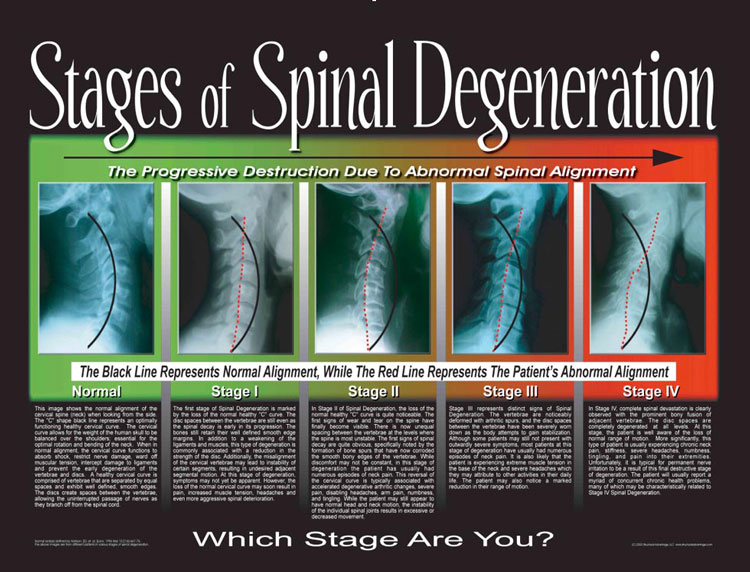 Chiropractic Bismarck ND Stages Of Spinal Degeneration Structural Alignment Blog