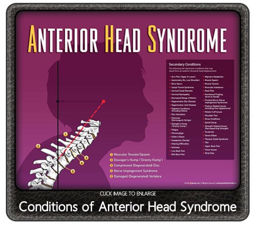 Chiropractic Bismarck ND Anterior Head Syndrome